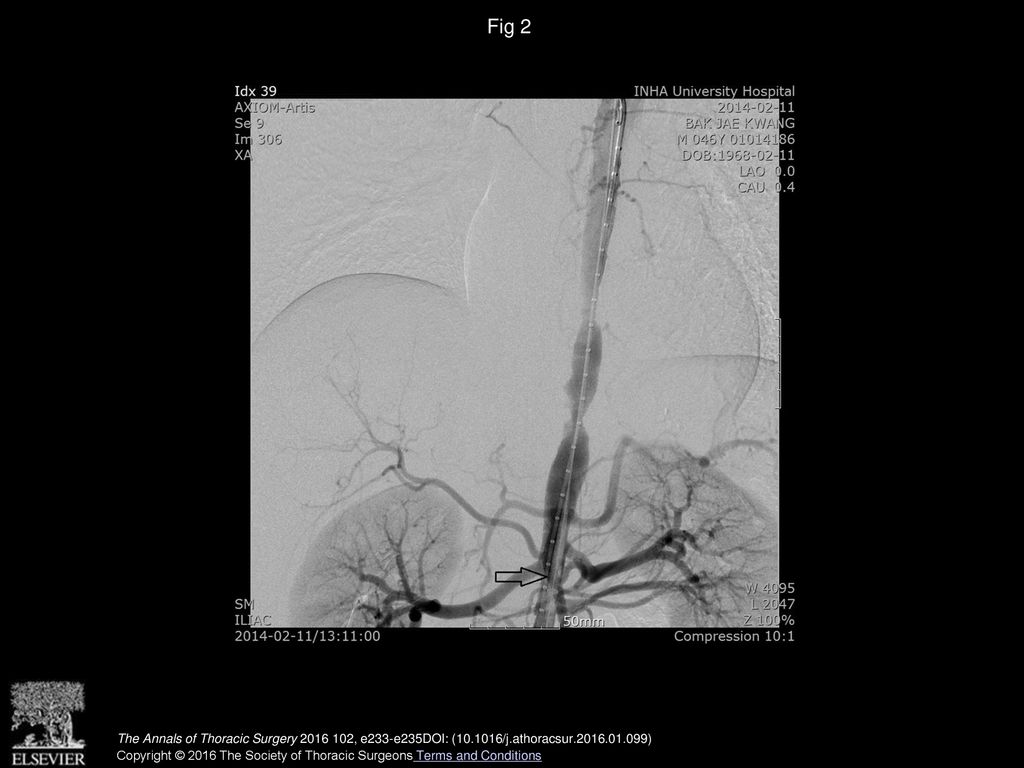 Fig 2 The stent graft (arrow) is advancing to the stenosis lesion.
