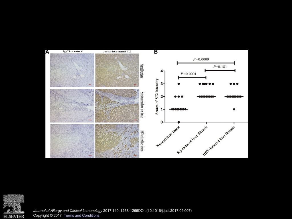 ST2 protein levels are increased in Schistosoma species–induced liver fibrosis.