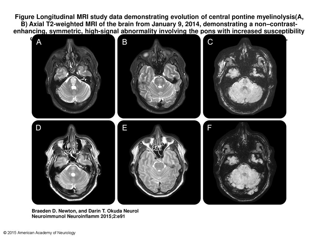 Figure Longitudinal MRI study data demonstrating evolution of central pontine myelinolysis(A, B) Axial T2-weighted MRI of the brain from January 9, 2014, demonstrating a non–contrast-enhancing, symmetric, high-signal abnormality involving the pons with increased susceptibility characteristics observed on the susceptibility-weighted imaging (SWI) sequence (C).