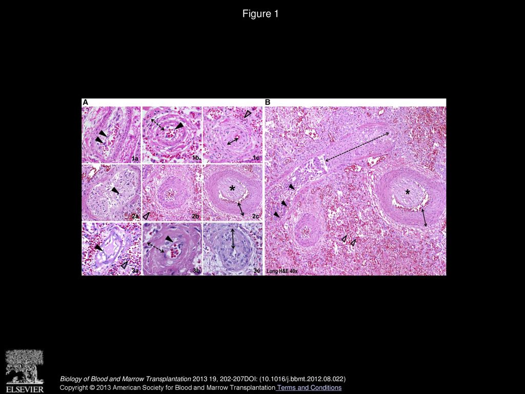 Pulmonary arterial hypertension in pediatric patients with