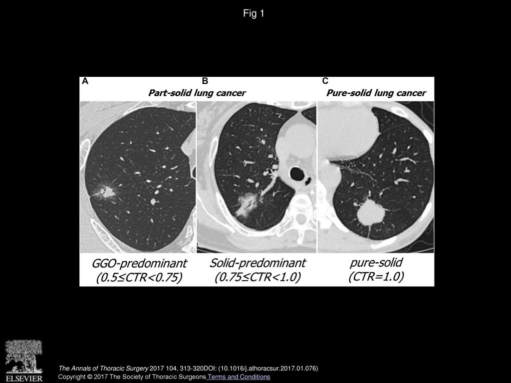 Importance of Ground Glass Opacity Component in Clinical Stage IA ...