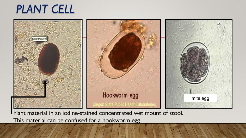 Plant cell Plant cell and hookworm and mite egg. mite egg. Plant material in an iodine-stained concentrated wet mount of stool.