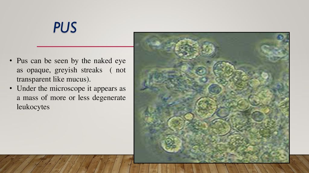 Pus Pus can be seen by the naked eye as opaque, greyish streaks ( not transparent like mucus).