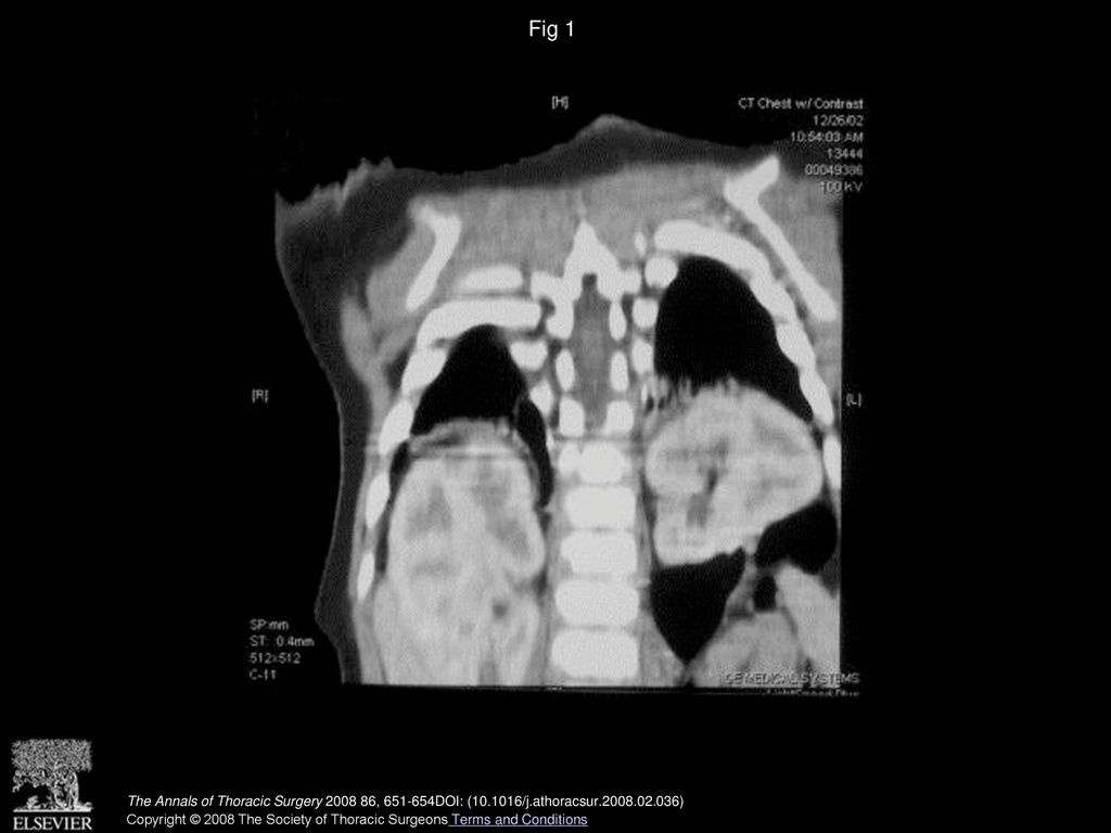 Fig 1 Coronal view of chest computed tomographic scan demonstrating bilateral intrathoracic renal and adrenal glands.