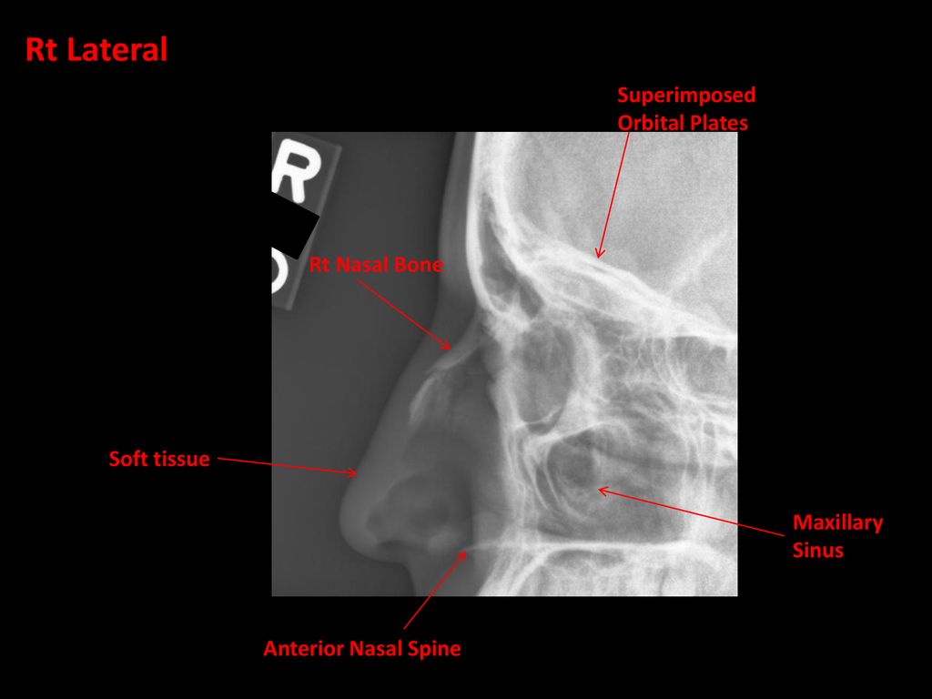 nasal bone x ray anatomy