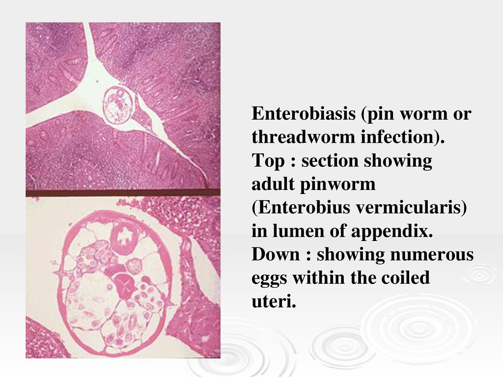 kenet a pinworm enterobiasis miatt