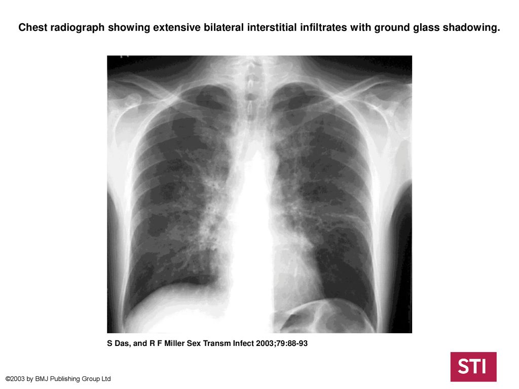 Chest radiograph showing extensive bilateral interstitial infiltrates ...