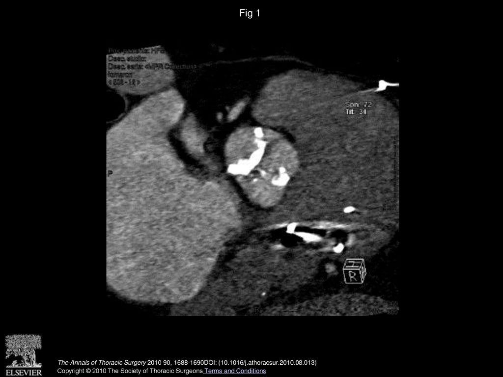 Fig 1 Computed tomographic scan showing the severe calcification of the valve with an asymmetrical tricuspid aspect.