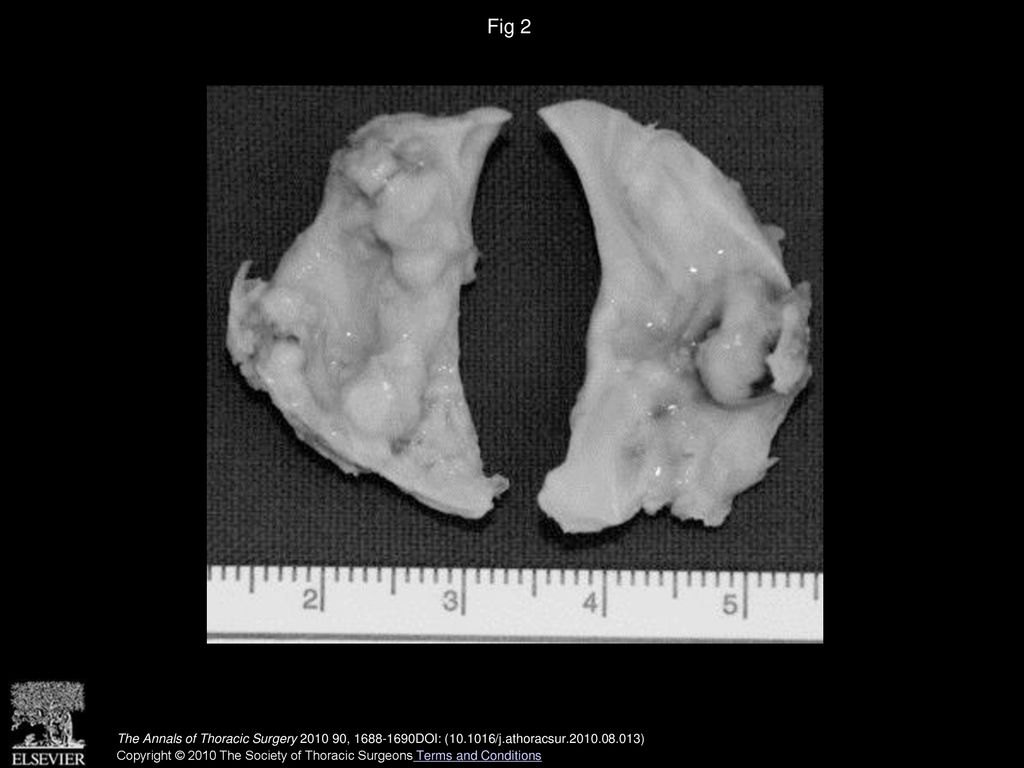 Fig 2 The aortic valve after surgical excision was extensively calcified with commissural fusion.