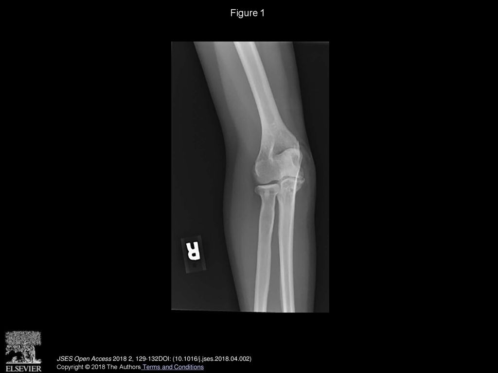 Recurrent tardy ulnar collateral ligament insufficiency due to cubitus ...