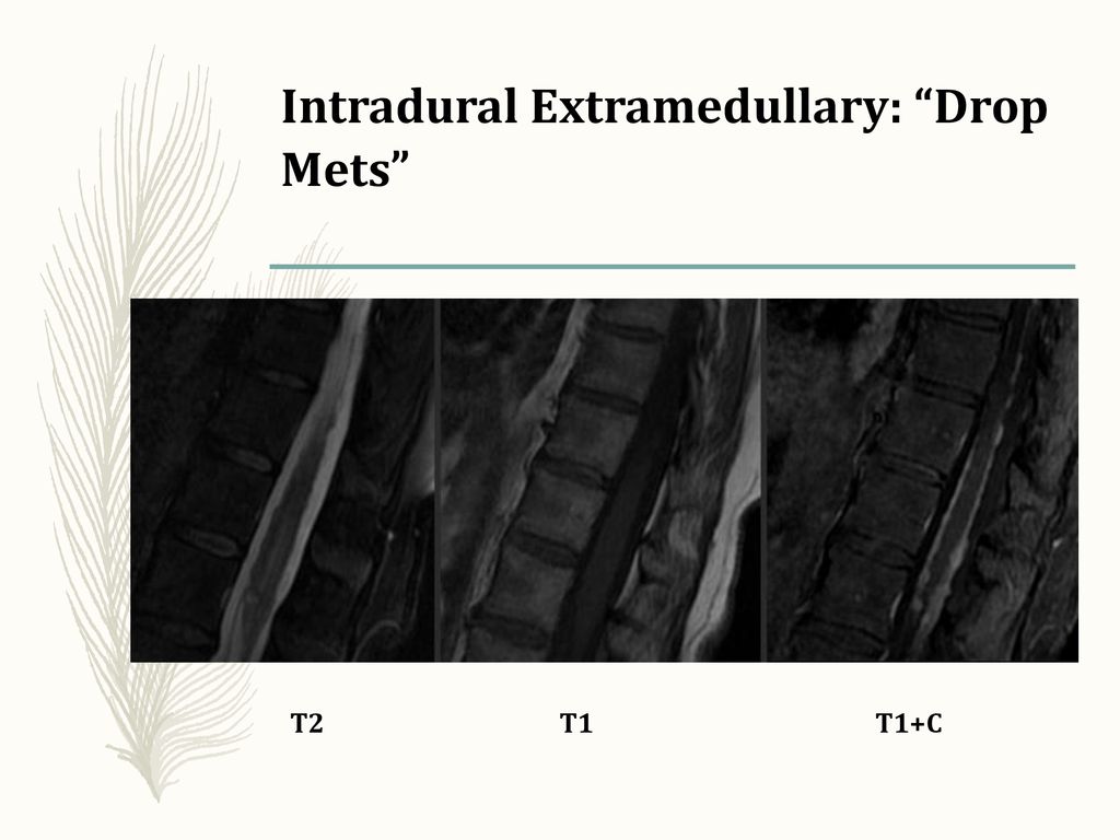 Intradural Extramedullary: Drop Mets