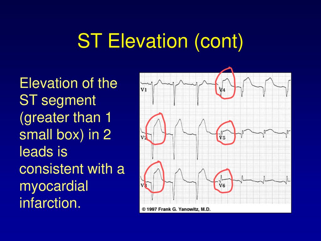 ST Elevation (cont) Elevation of the ST segment (greater than 1 small box) in 2 leads is consistent with a myocardial infarction.