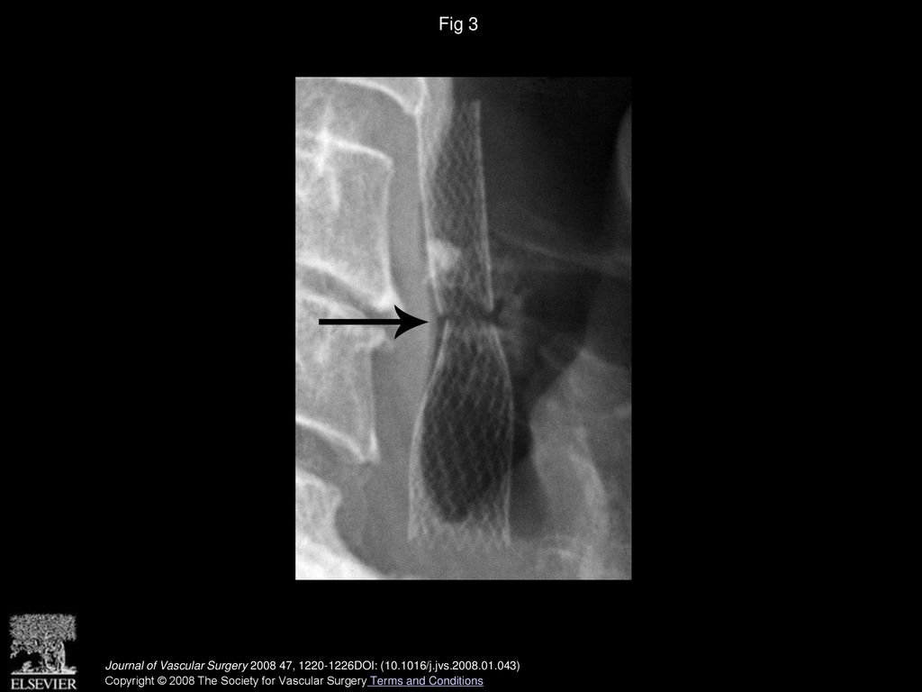 Stenting for carotid artery stenosis: Fractures, proposed etiology and ...