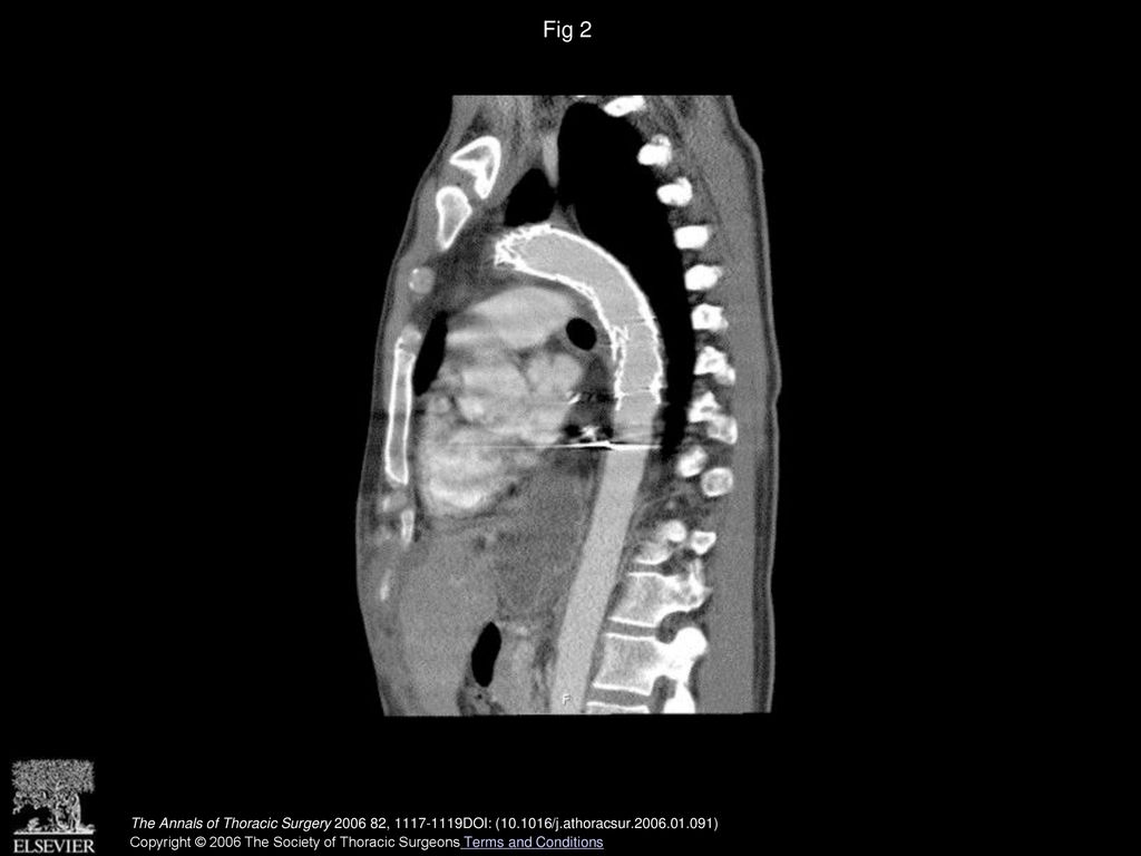 Fig 2 Computed tomographic scan showing the stent-grafts in the aorta.