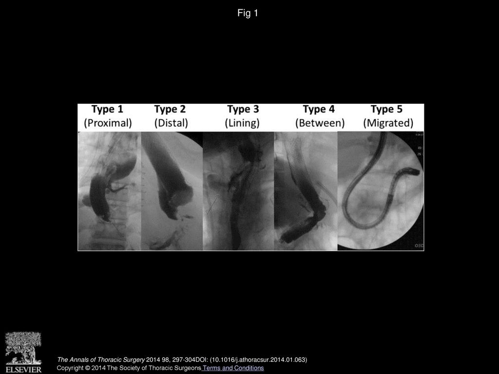 Fig 1 Fluoroscopic imaging illustrating the different types of esophageal stent leaks (type 1 to type 5).