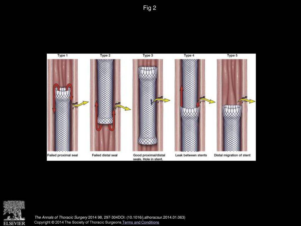 Fig 2 Stent lining leaks (types 1 to 5).