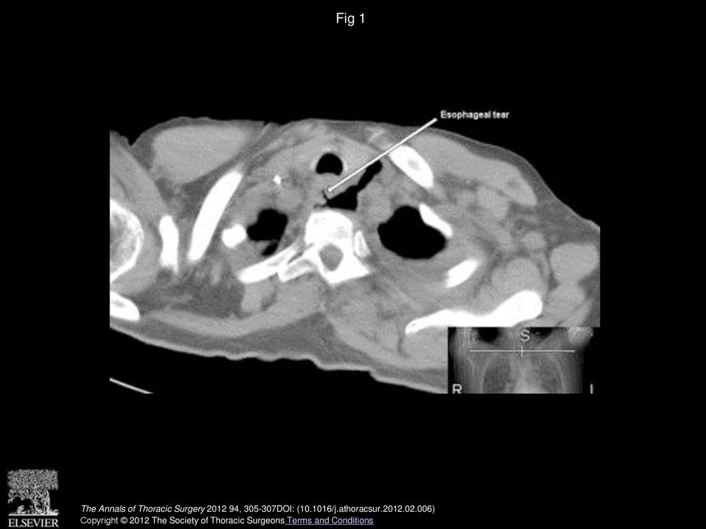 Fig 1 Axial computed tomographic scan slice at the level of the lower neck. Arrow points to the tear through the esophageal wall.