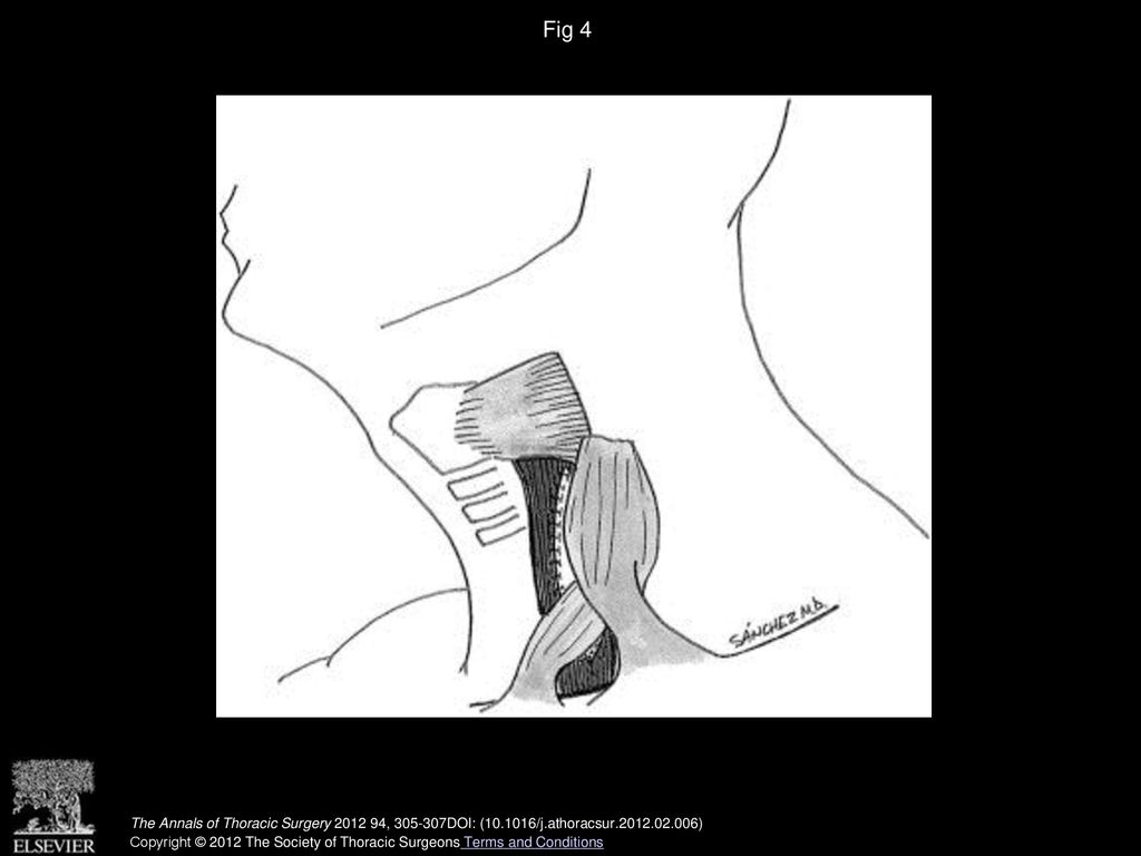 Fig 4 Illustration of the completed flap.