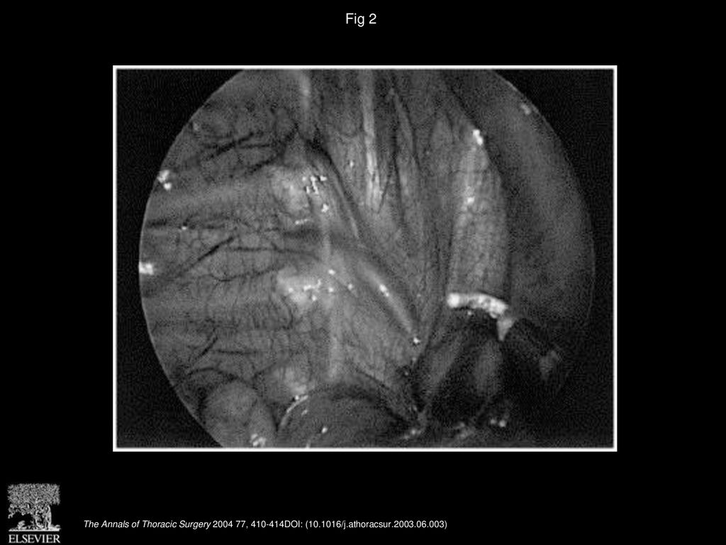 Thoracoscopic Sympathectomy For Hyperhidrosis: Indications And Results ...