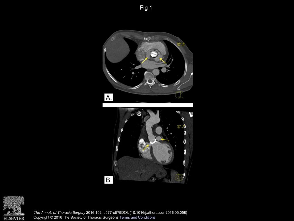 Fig 1 (A and B) Preoperative computed tomography scan. The yellow arrows indicate the aortoventricular fistulae.