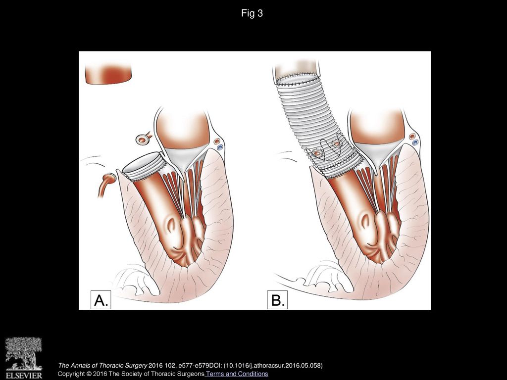 Fig 3 (A) Intraventricular Dacron graft insertion. (B) A second composite graft is anastomosed to the first one.