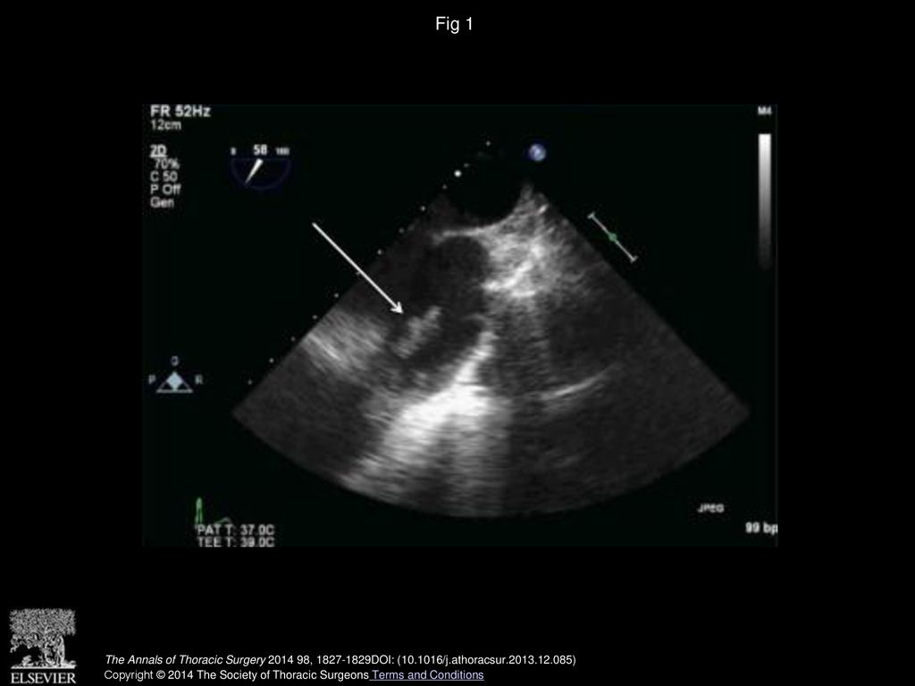Fig 1 Transesophageal echocardiogram demonstrating a 3-cm vegetation on pulmonary valve (arrow).
