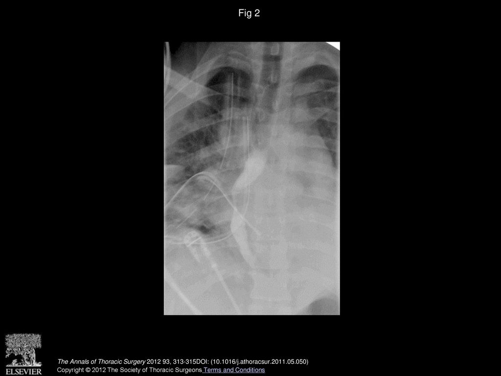 Fig 2 Postoperative cine-esophagogram demonstrating resolution of the fistula.