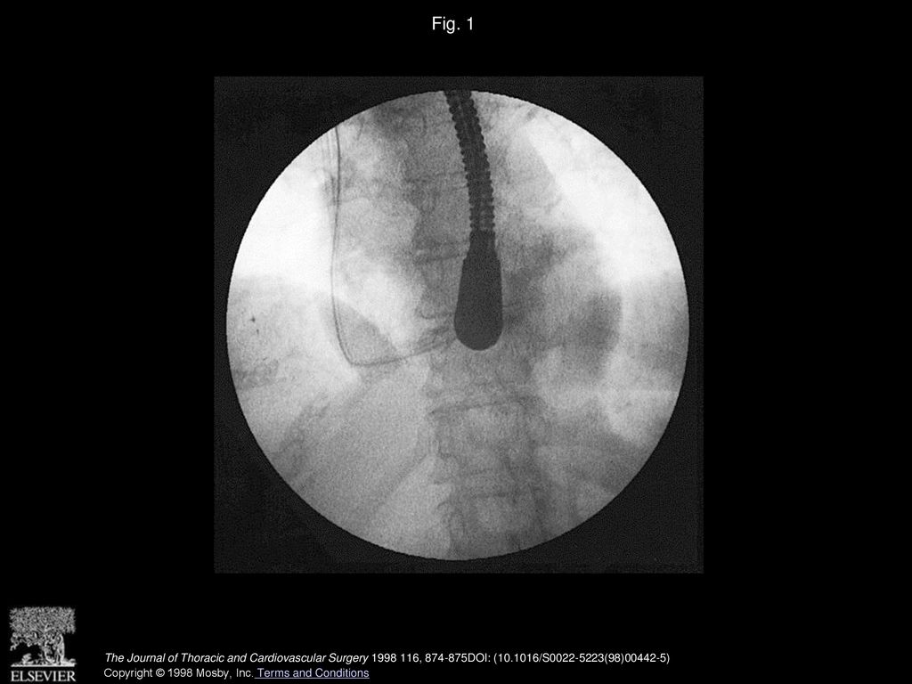 Fig. 1 Fluoroscopic-radiographic picture of ESC into the coronary sinus.