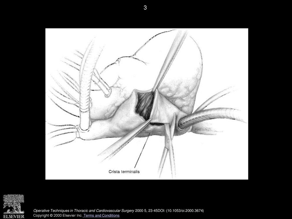 How I Perform the Maze Procedure - ppt download