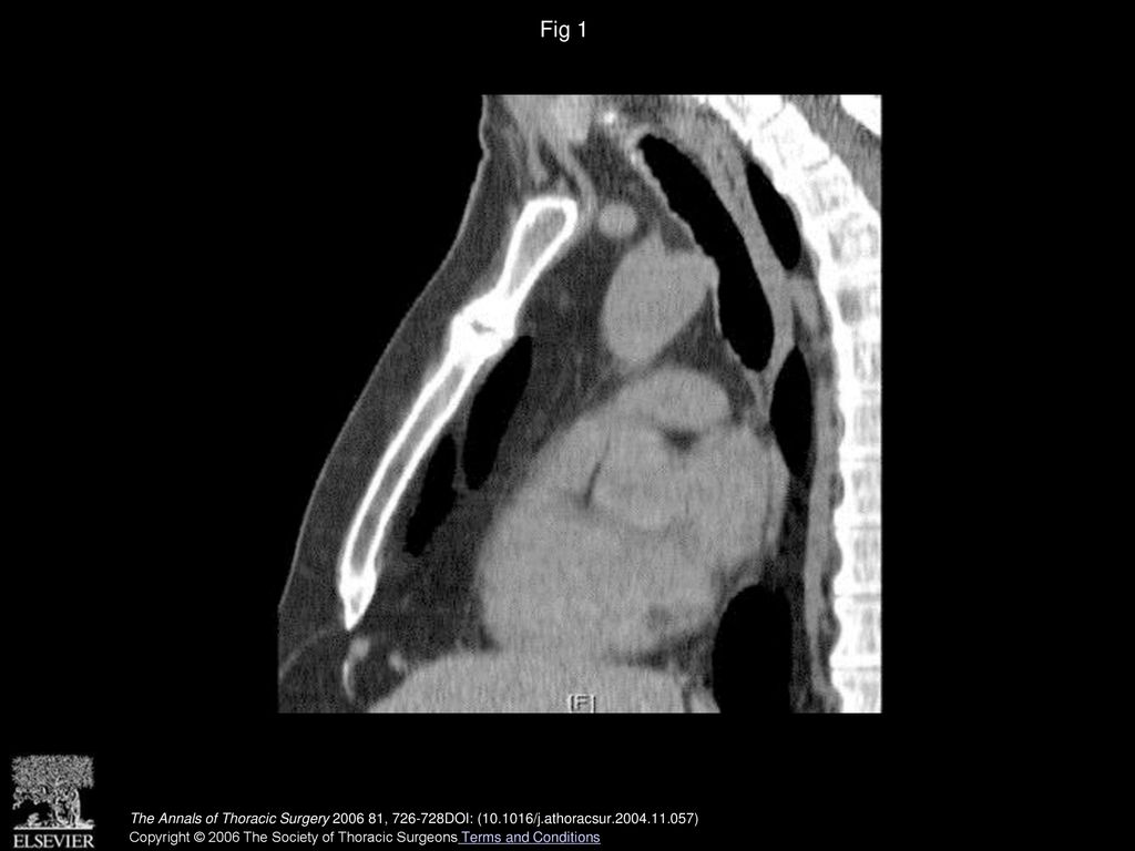 Fig 1 Computed tomographic scan showing fracture at the sternomanubrial junction.