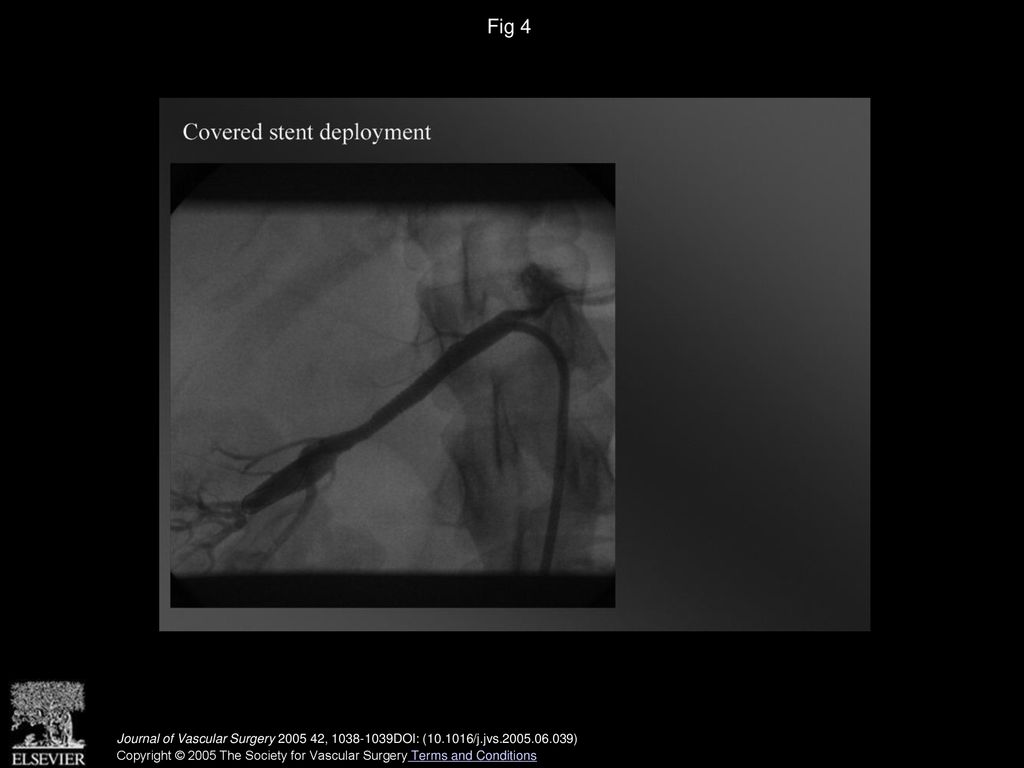 Fig 4 Ruptured renal artery repaired with two balloon-expandable covered stents.