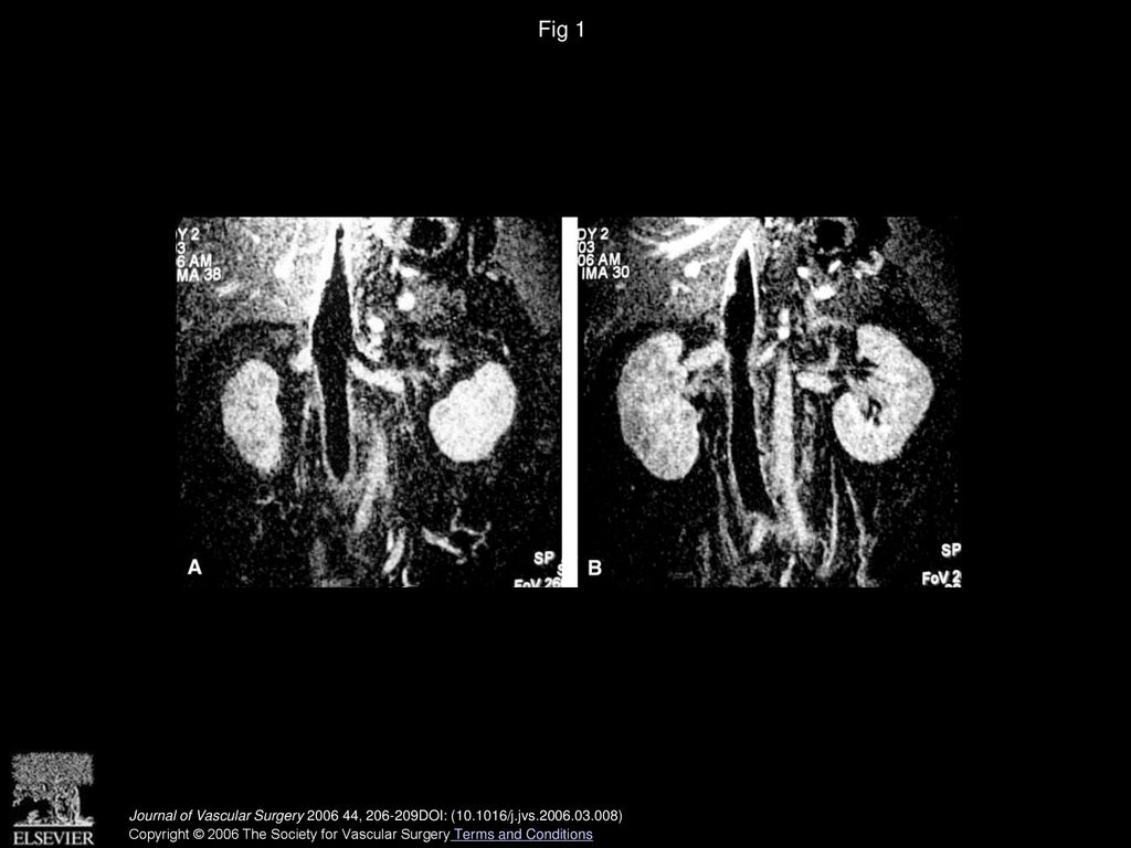 Fig 1 A and B, Magnetic resonance venography of the inferior vena cava shows occlusion with thrombus extending into the renal and iliac veins.
