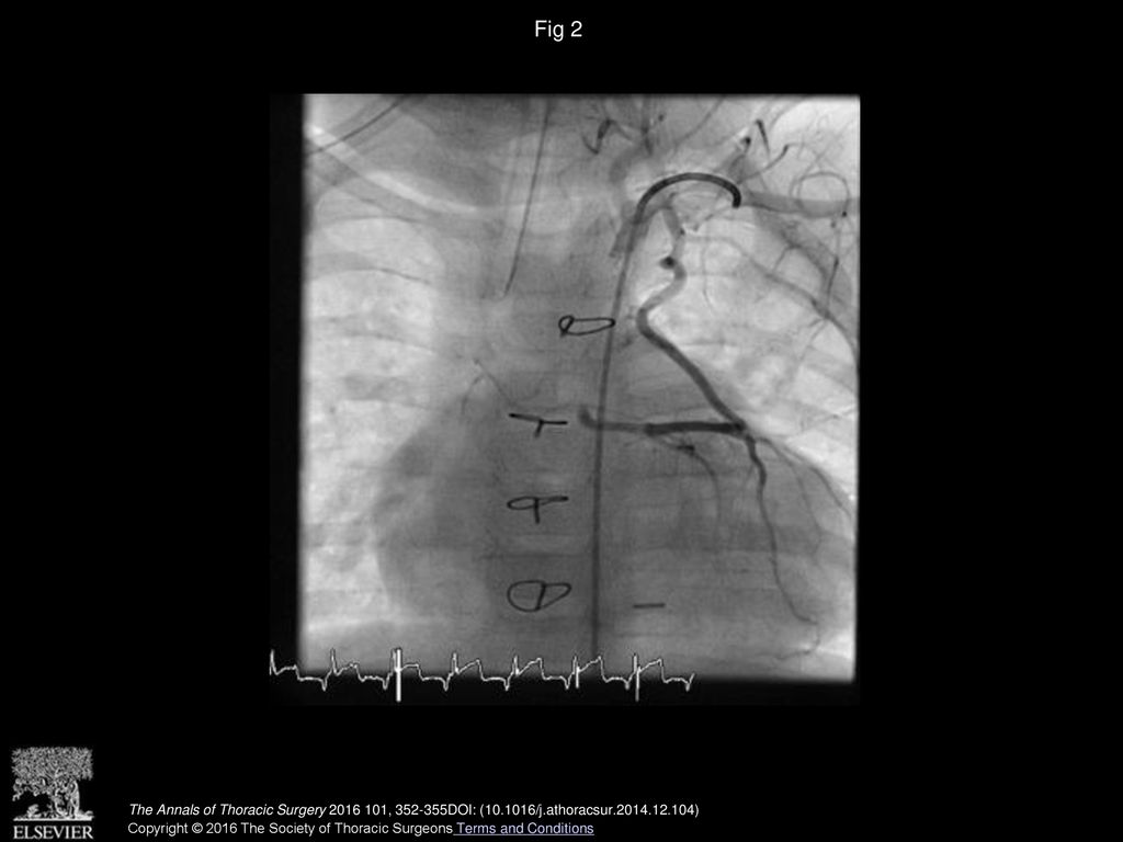 Fig 2 Postoperative angiogram showing flow into the patent left internal mammary artery (LIMA) graft.