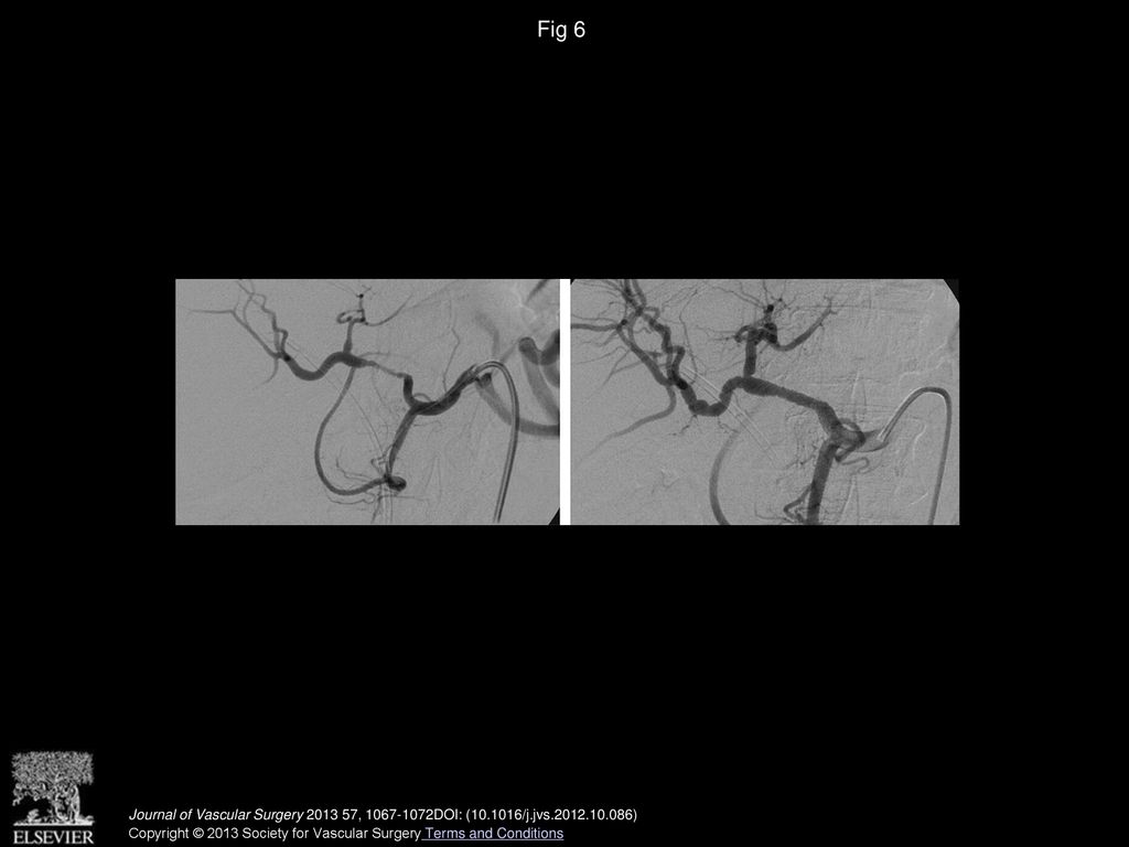 Fig 6 Hepatic artery angiogram before (left) and after (right) angioplasty and stent placement.
