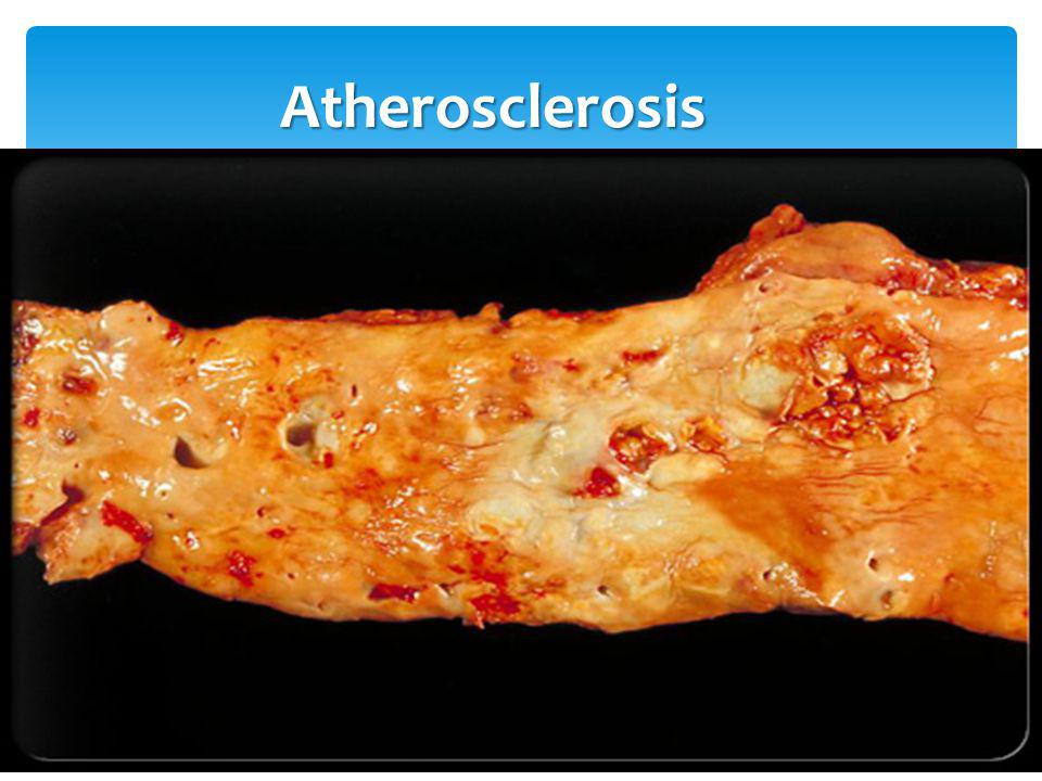 Atherosclerosis.jpg