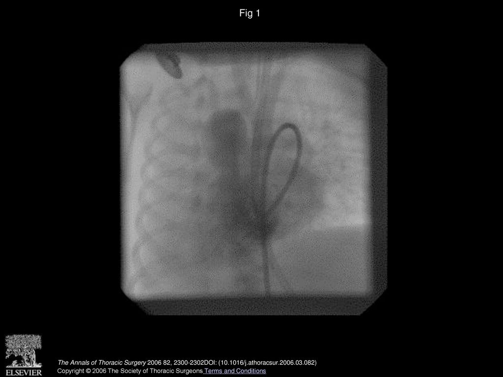 Fig 1 Preoperative cardiac catheterization depicting a right-sided interrupted aortic arch.