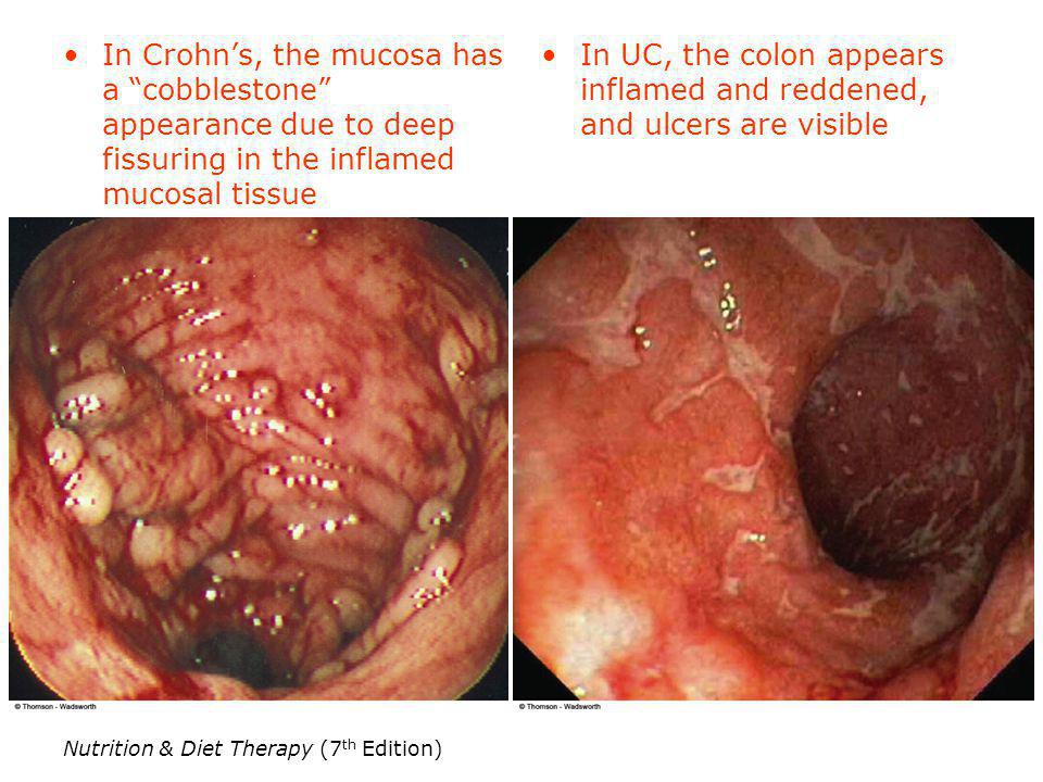In UC, the colon appears inflamed and reddened, and ulcers are visible