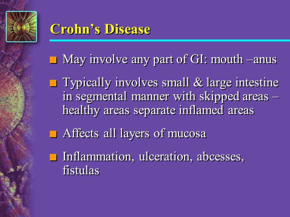 Crohn’s Disease May involve any part of GI: mouth –anus