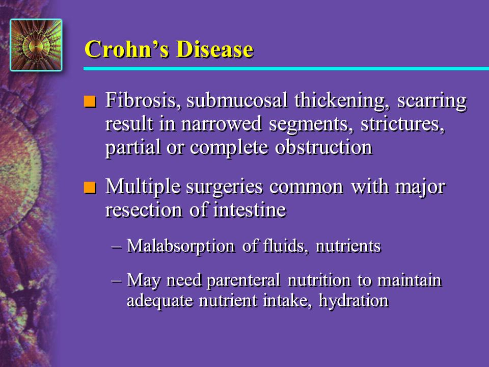 Crohn’s Disease Fibrosis, submucosal thickening, scarring result in narrowed segments, strictures, partial or complete obstruction.