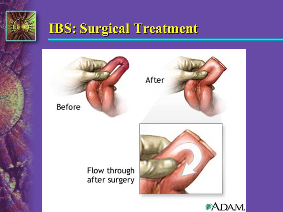 IBS: Surgical Treatment