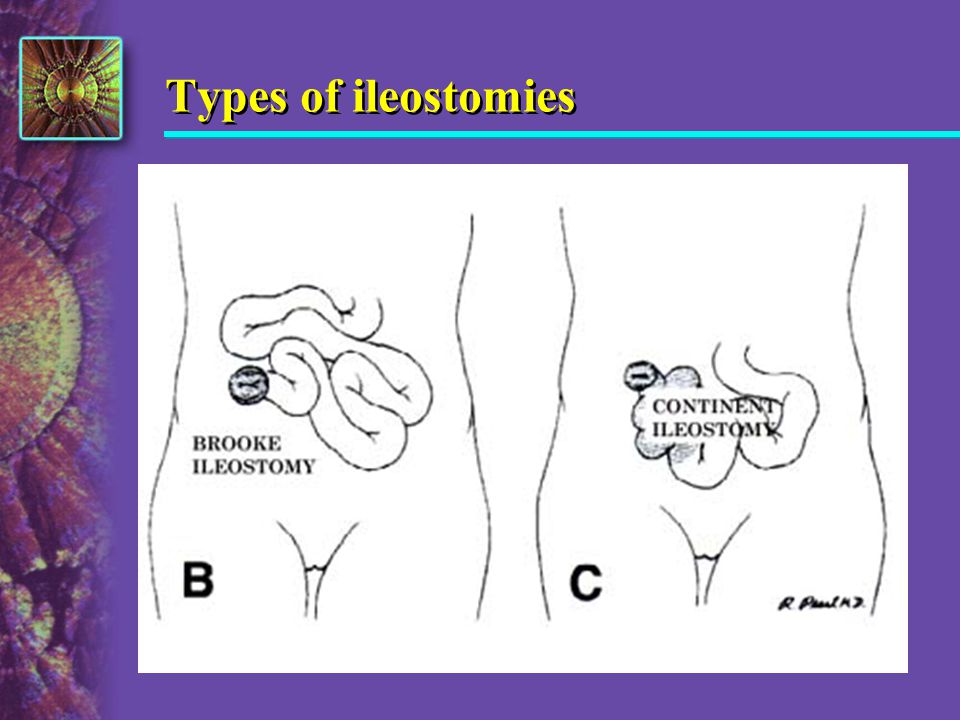 Types of ileostomies