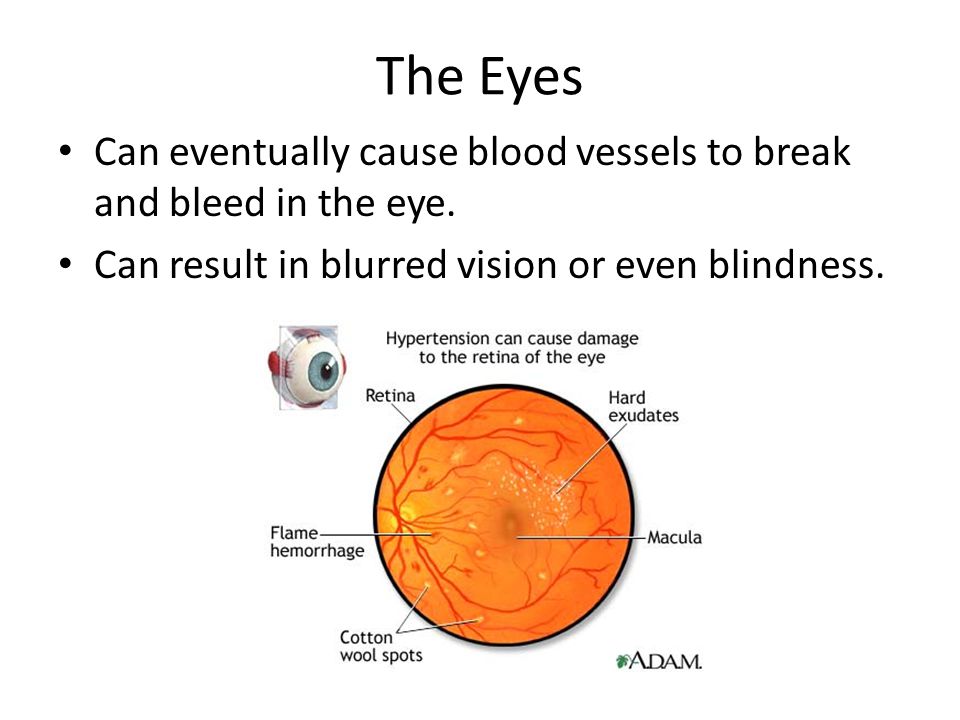 The Eyes Can eventually cause blood vessels to break and bleed in the eye. Can result in blurred vision or even blindness.