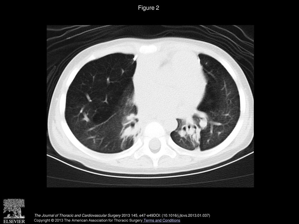 Figure 2 Postoperative chest computed tomographic scan showing aerated lung of the lower lobes.