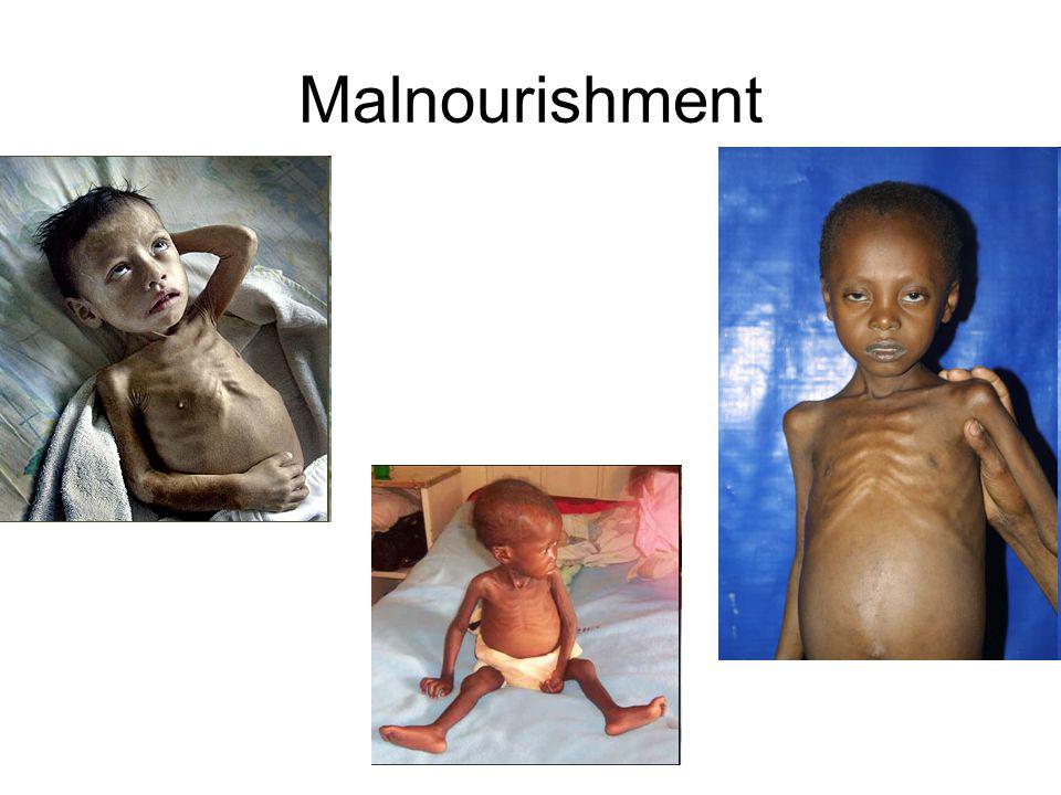 Malnourishment