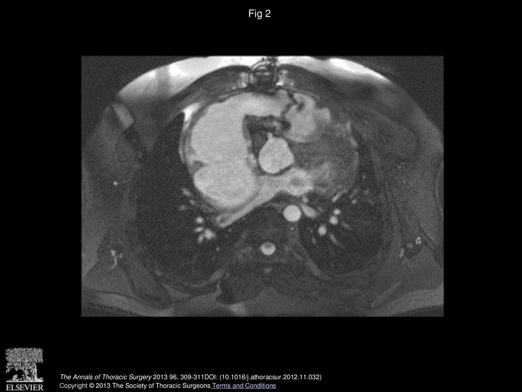 Fig 2 Postoperative cardiovascular magnetic resonance, 6 months after surgery.