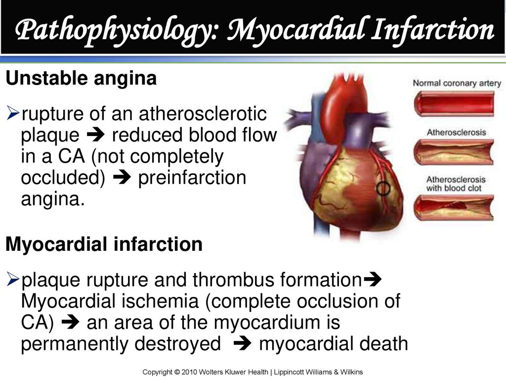 Chapter 28 Management of Patients With Myocardial Infarction - ppt download