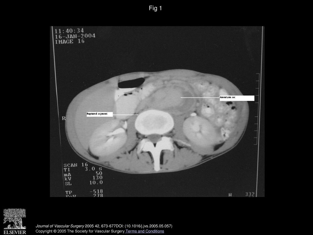 The Surgical Treatment Of Arterial Aneurysms In Beh et Disease A the-surgical-treatment-of-arterial-aneurysms-in-beh-et-disease-a
