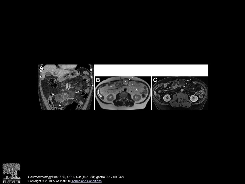 What does fatty mesenteric lymphadenopathy mean ppt download