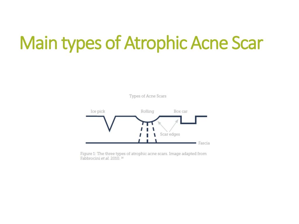 Main types of Atrophic Acne Scar