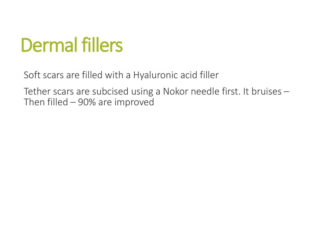 Dermal fillers Soft scars are filled with a Hyaluronic acid filler